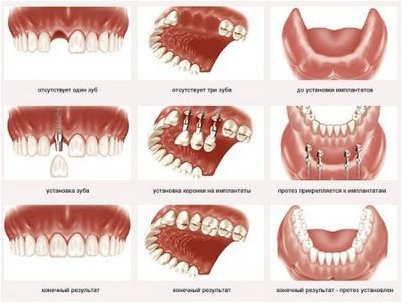 имплантаты