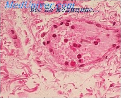 воспаление воспаление